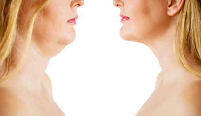 Chin lipo transformation before and after
