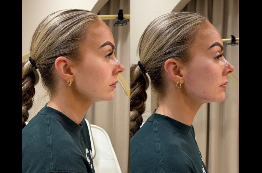 Will chin filler fix a double chin?