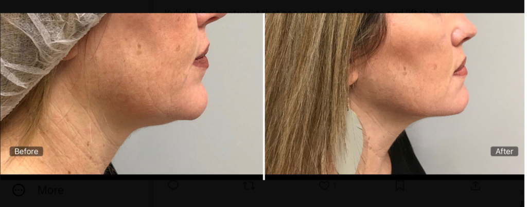 Kybella Before and After