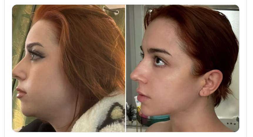 What a chin filler before and after actually shows
